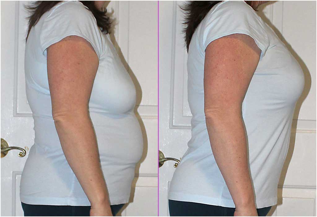 Real Life transformations in our "No Back Fat Bra" - Before & After  Pictures - Shapeez